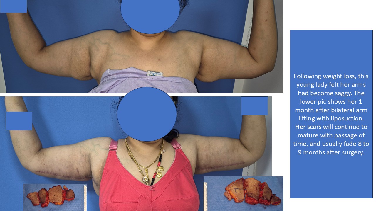 Arm Lift Surgery
