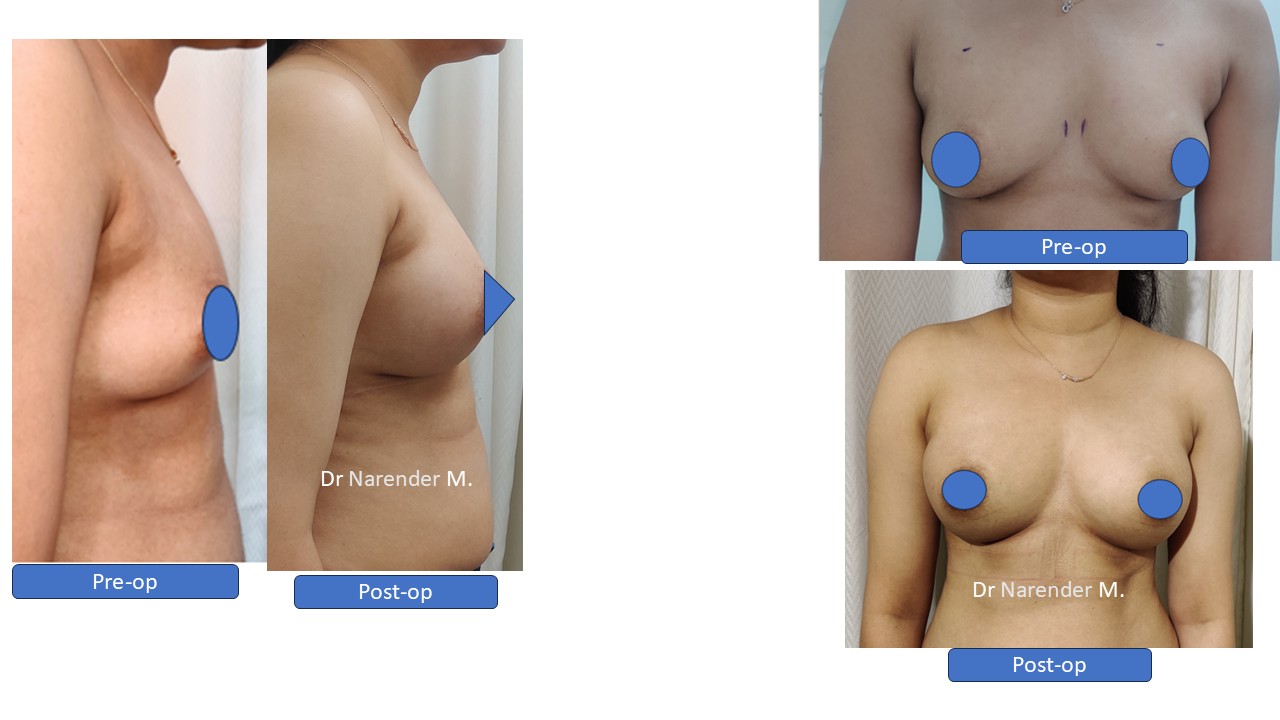 Breast Augmentation Photo 9