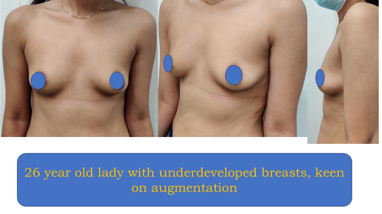 Breast Augmentation Photo 10