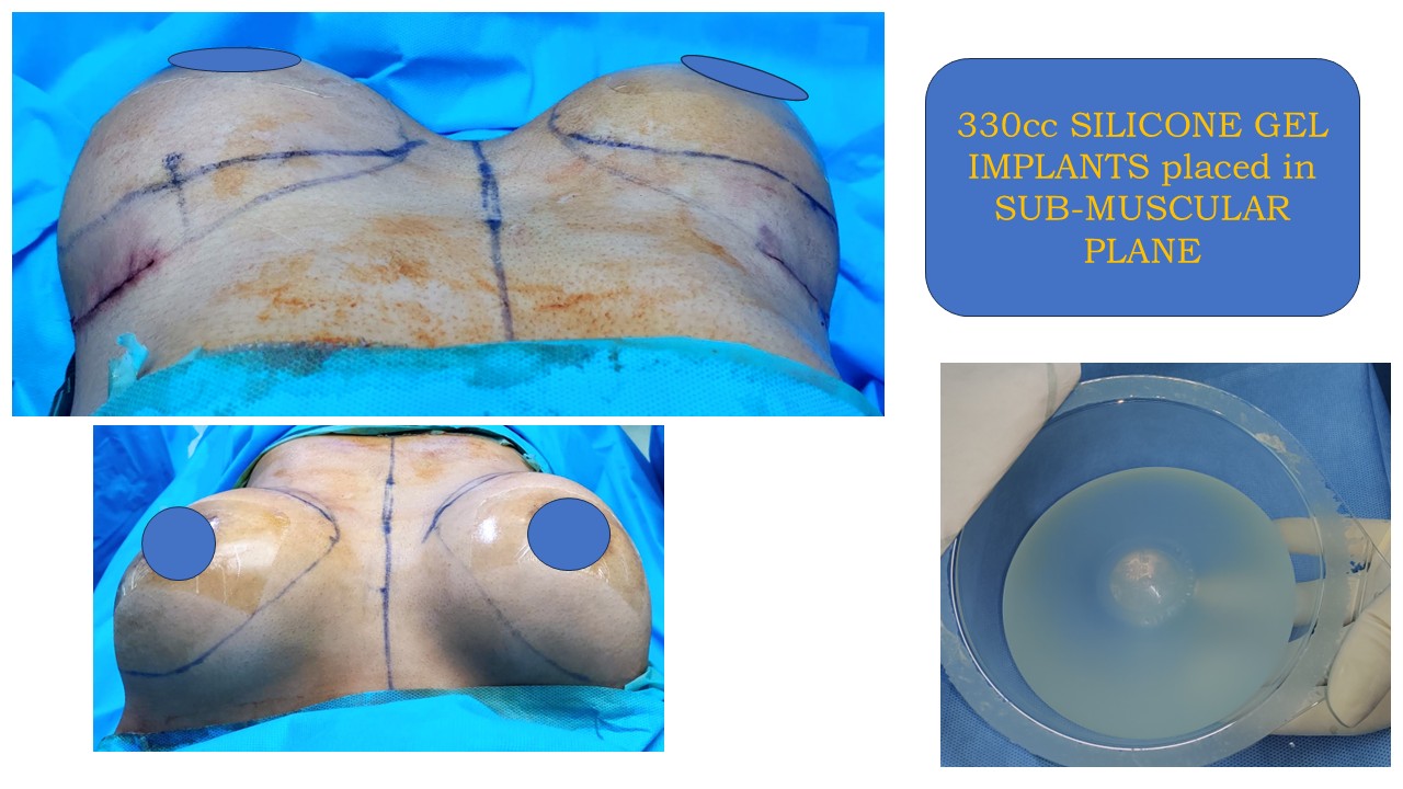 Breast Augmentation Photo 11