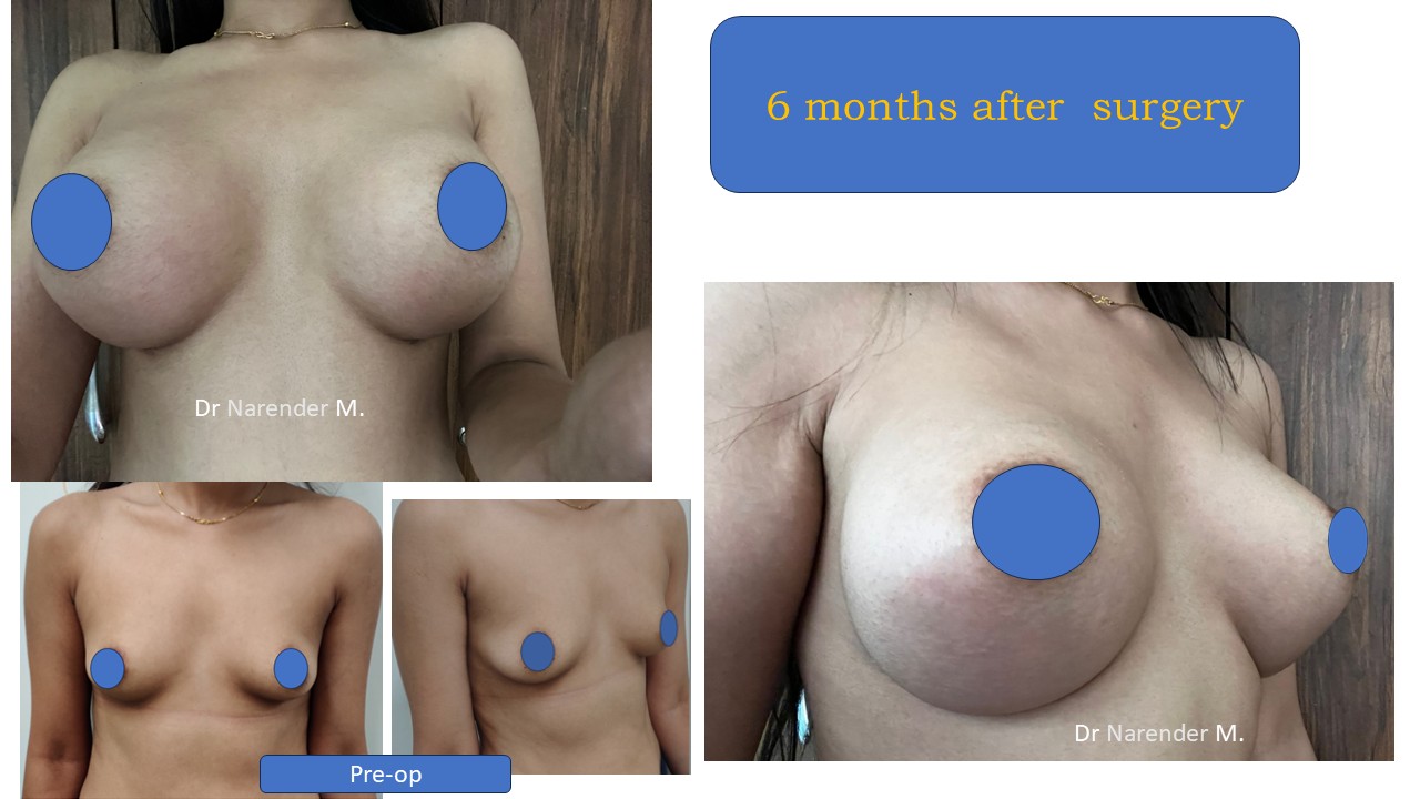 Breast Augmentation Photo 12