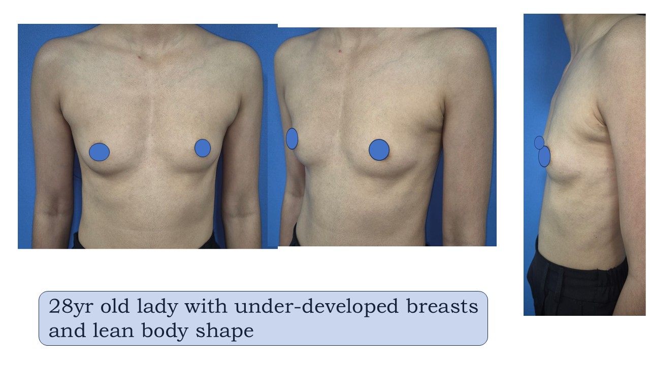 Breast Augmentation Photo 13