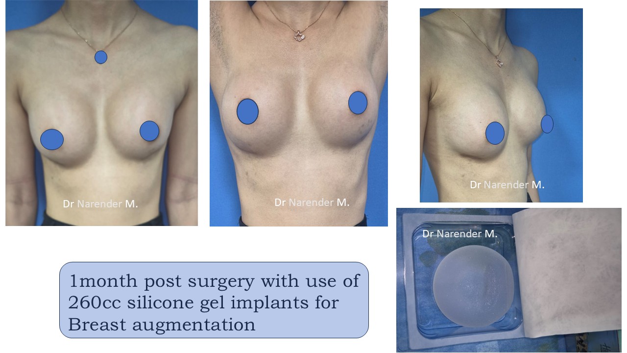 Breast Augmentation Photo 14
