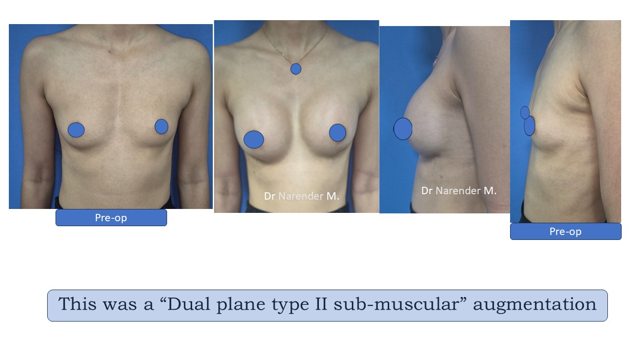 Breast Augmentation Photo 15