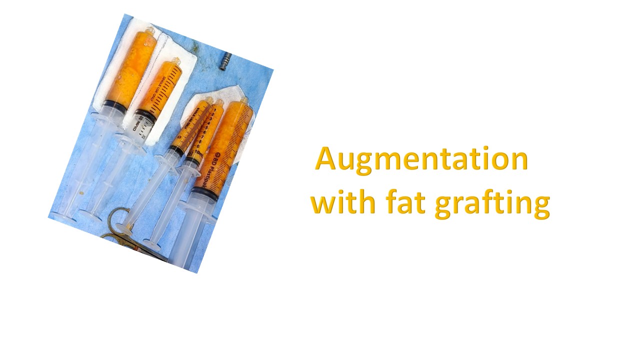 Breast Augmentation Photo 16