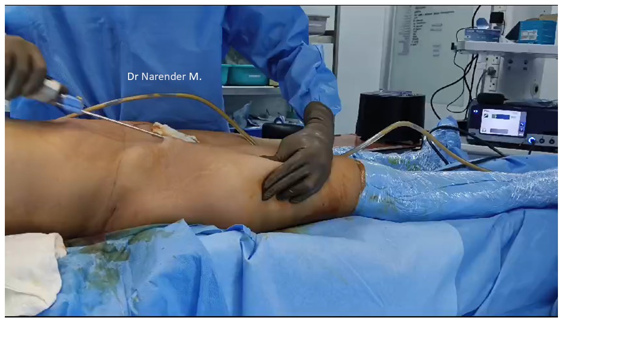 Breast Augmentation Photo 18