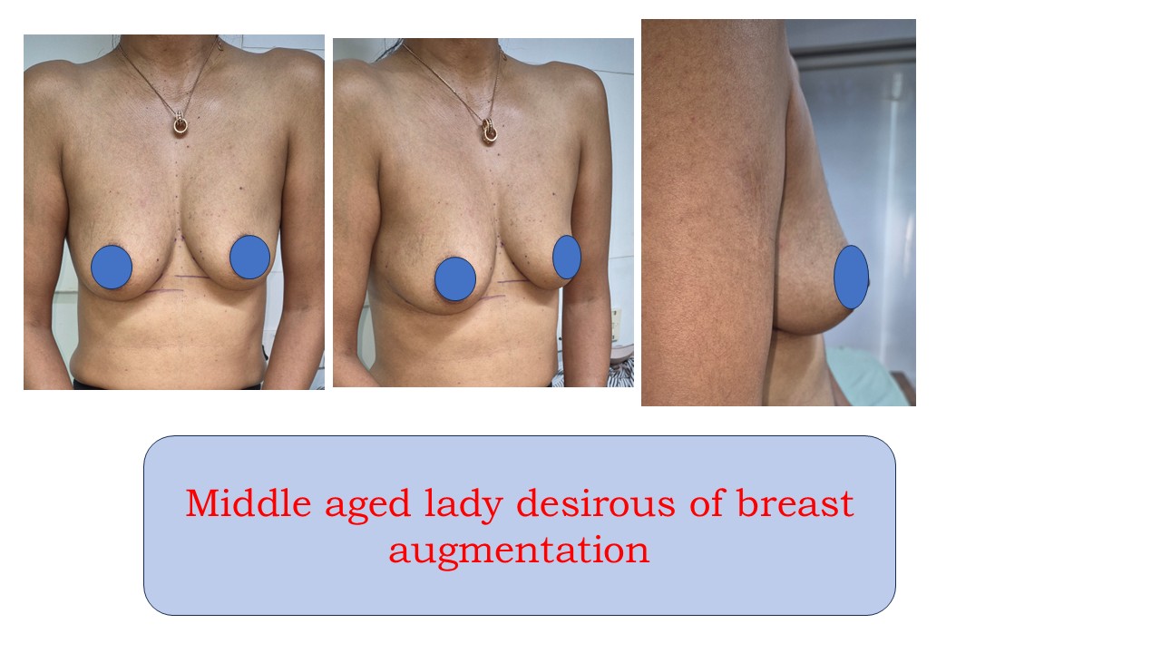 Breast Augmentation Photo 1