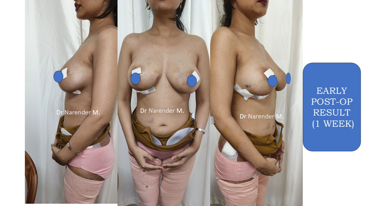 Breast Augmentation Photo 20