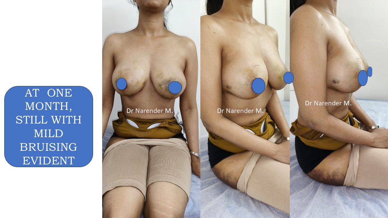 Breast Augmentation Photo 21
