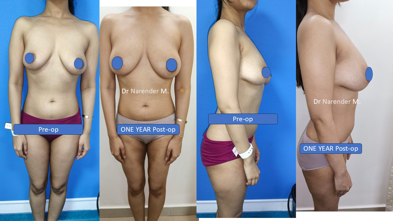 Breast Augmentation Photo 22