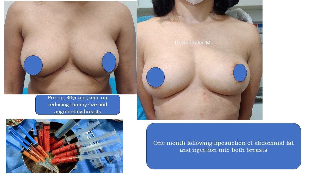 Breast Augmentation Photo 24