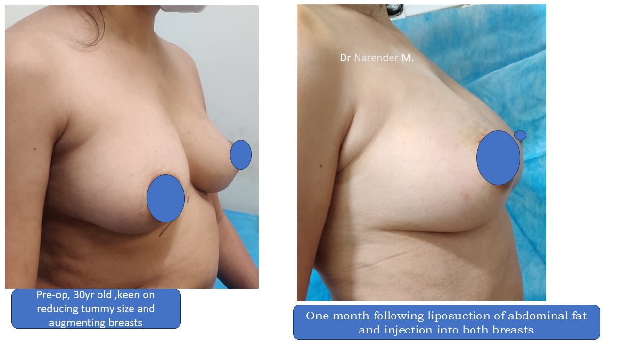 Breast Augmentation Photo 25