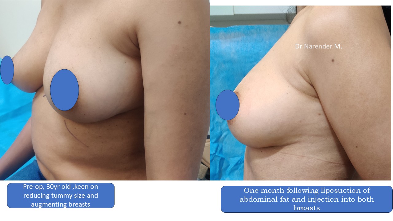 Breast Augmentation Photo 26