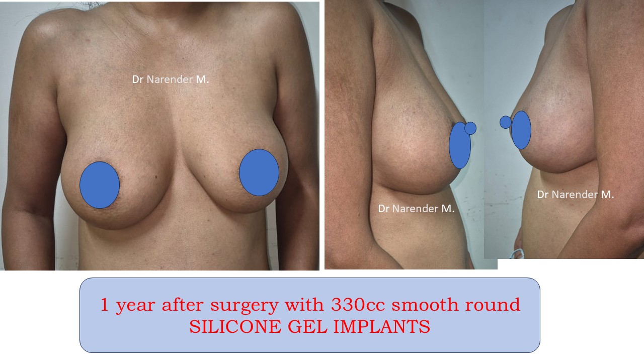 Breast Augmentation Photo 2