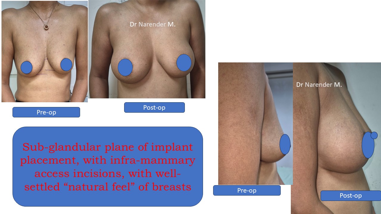Breast Augmentation Photo 3