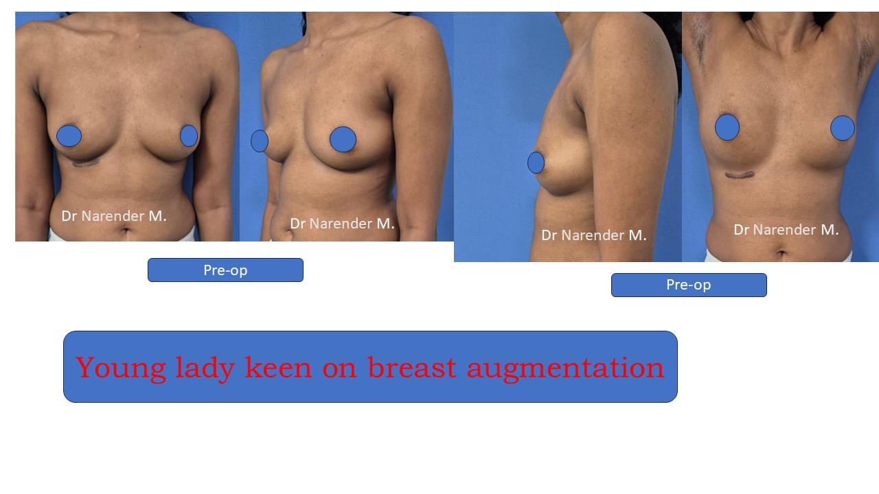 Breast Augmentation Photo 4