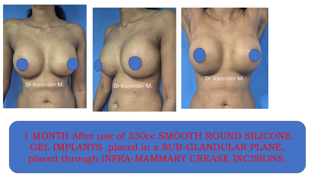 Breast Augmentation Photo 5