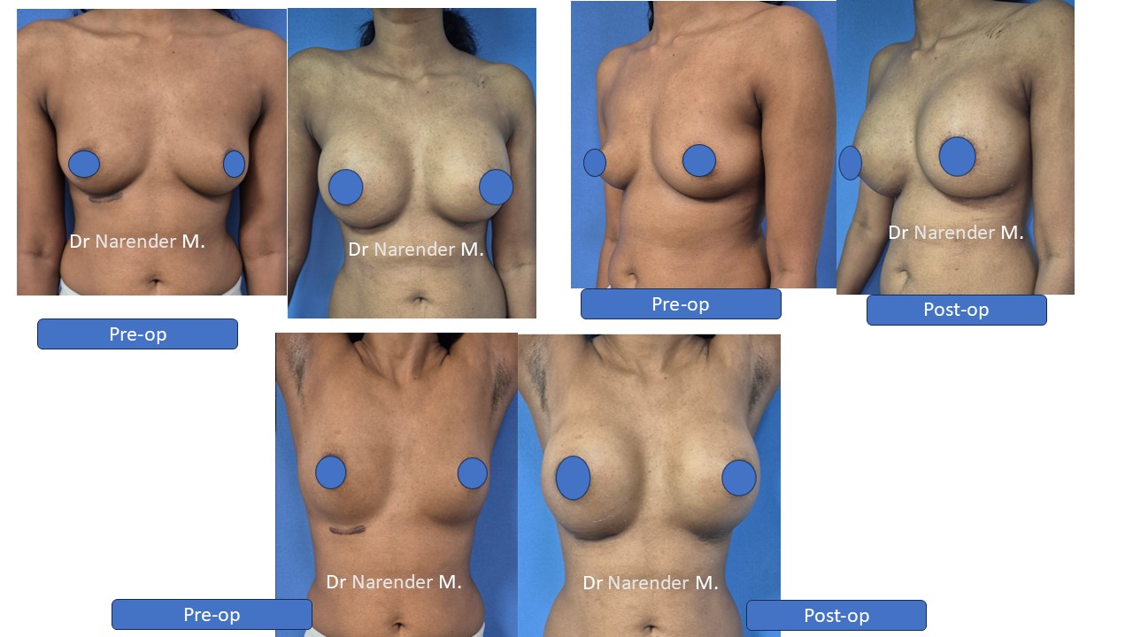 Breast Augmentation Photo 6