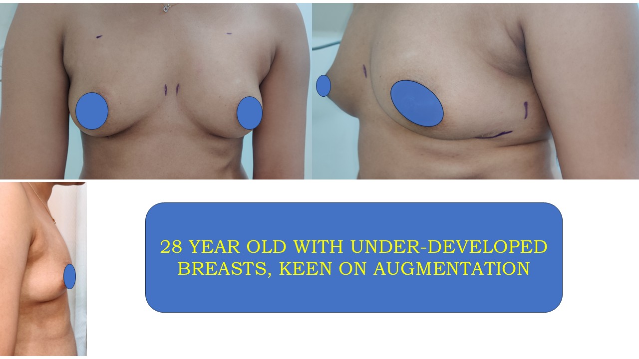 Breast Augmentation Photo 7