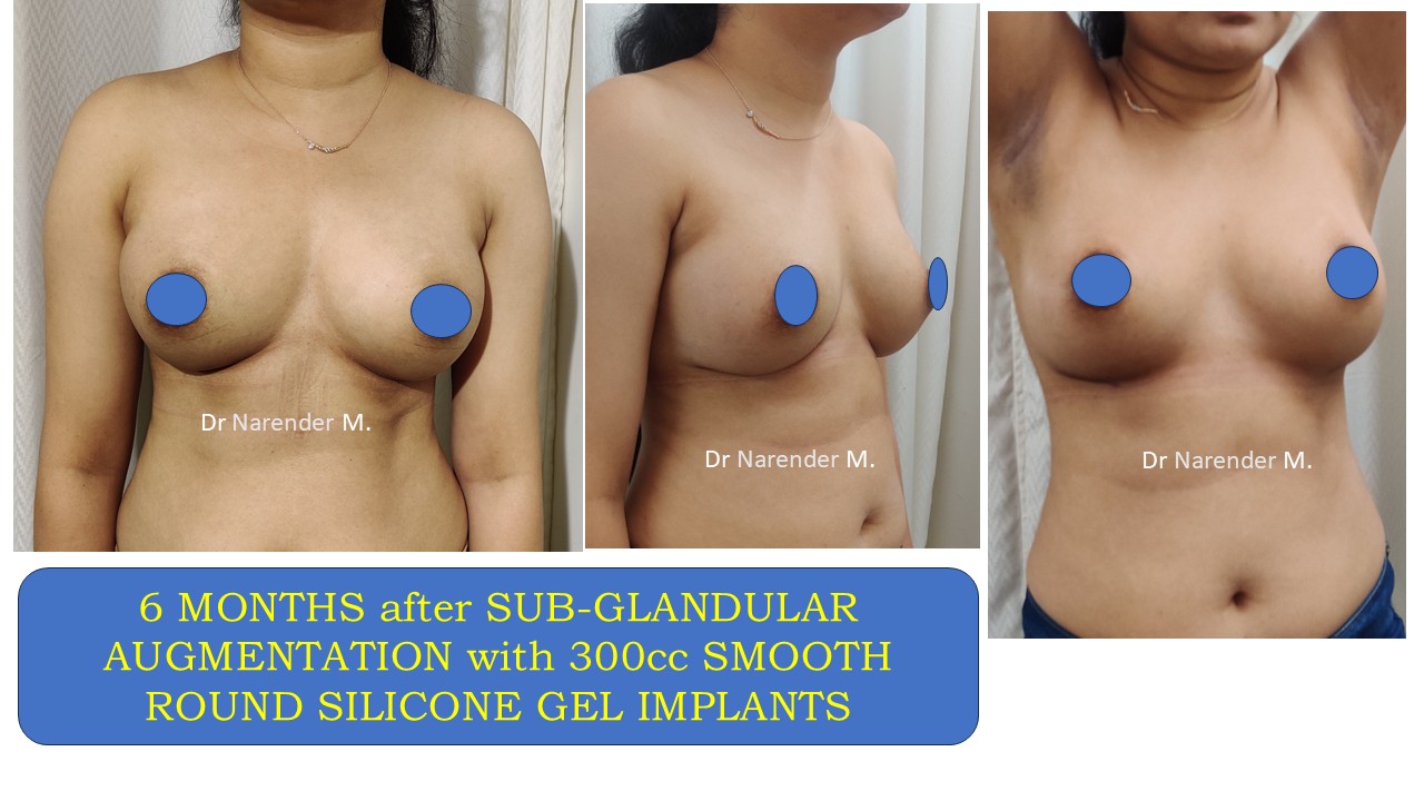 Breast Augmentation Photo 8