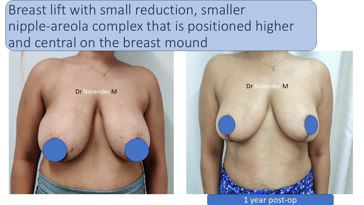 Breast Lift Photo 1