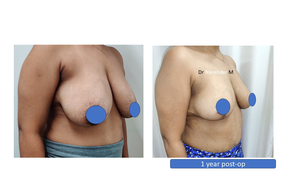Breast Lift Photo 2