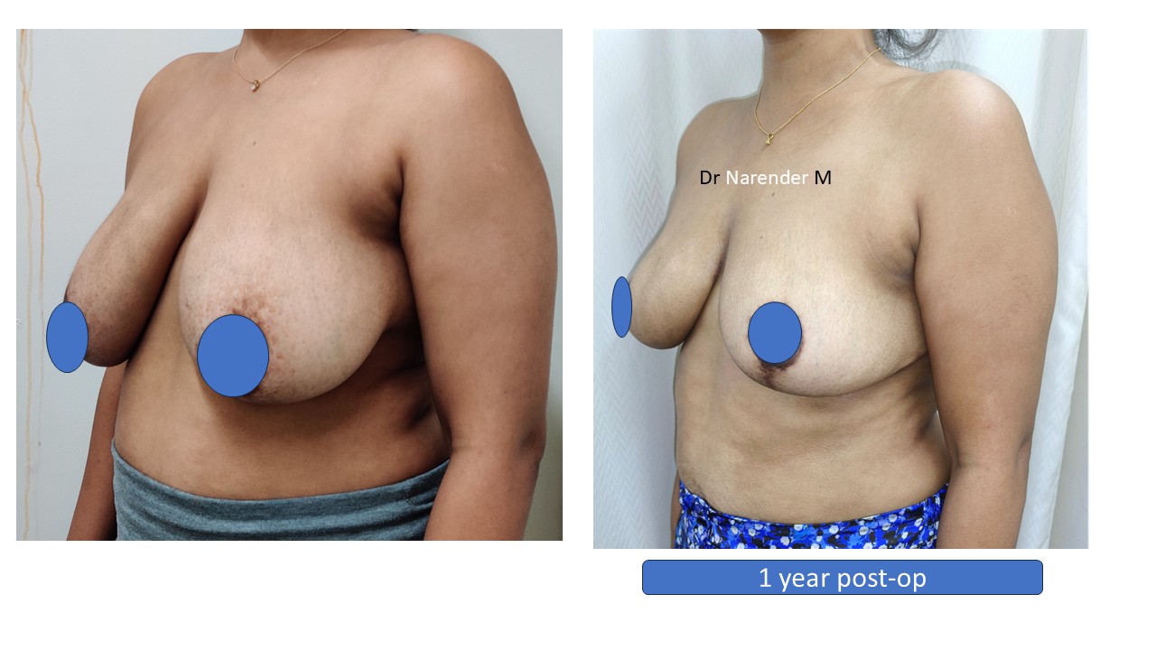 Breast Lift Photo 3