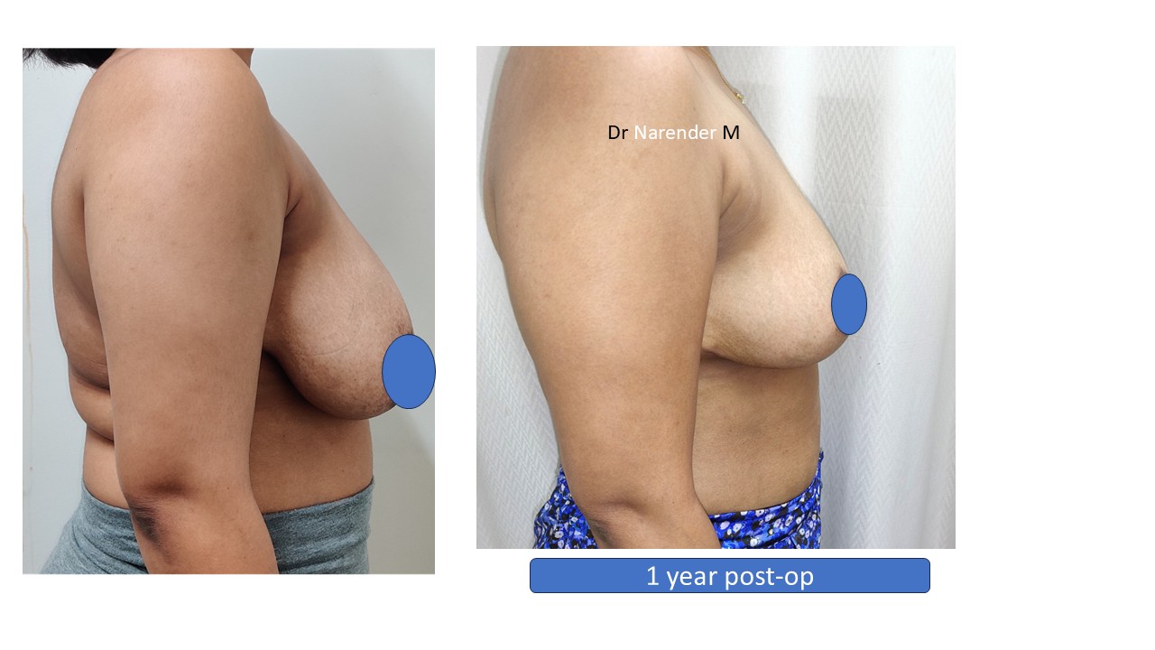 Breast Lift Photo 4