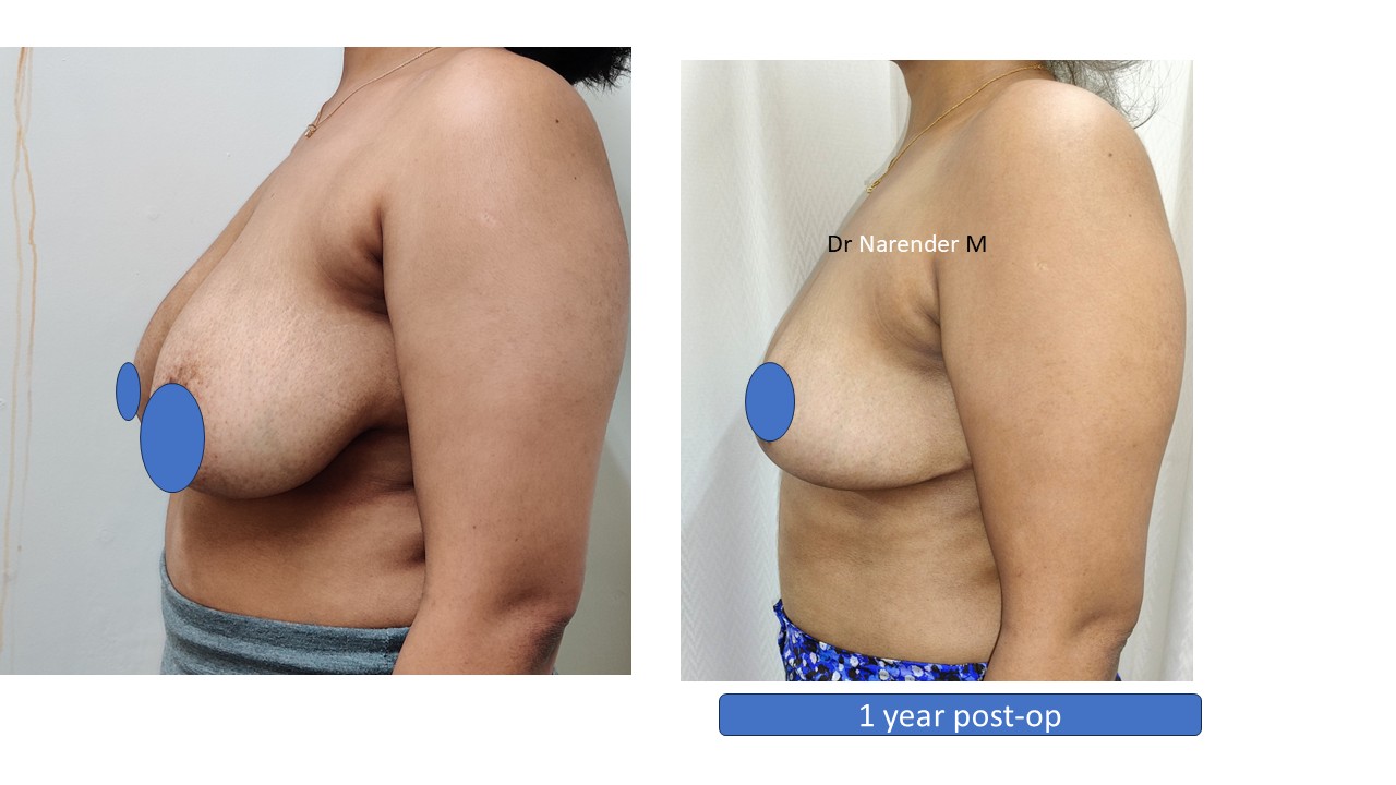 Breast Lift Photo 5