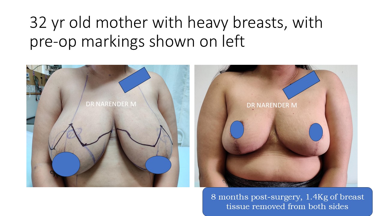 Breast Reduction Photo 1