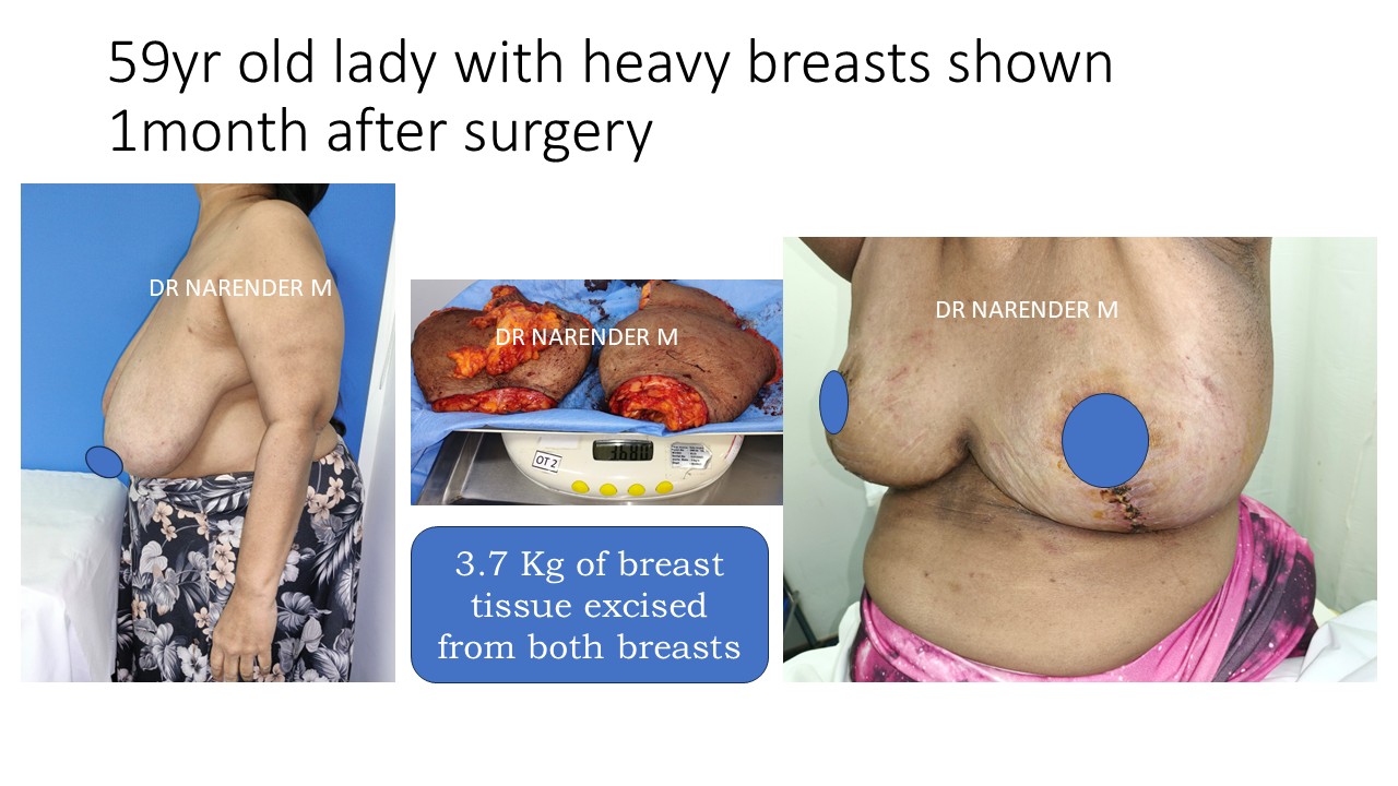 Breast Reduction Photo 10