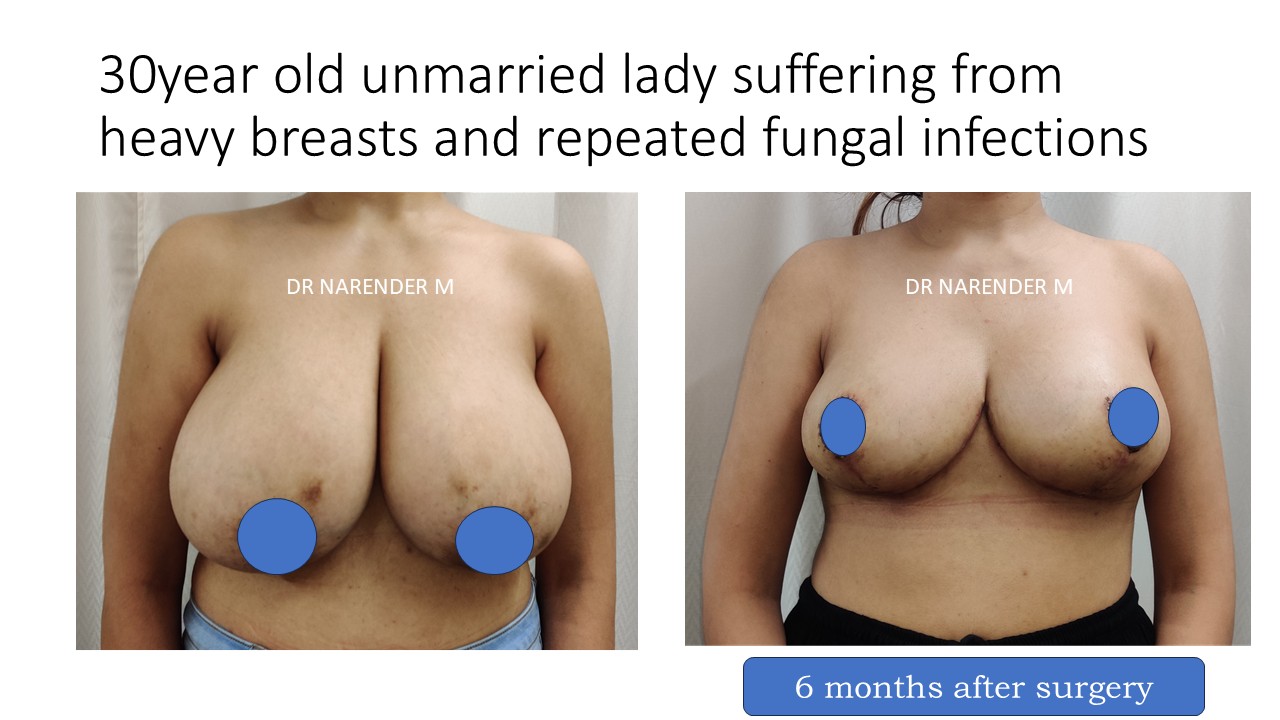 Breast Reduction Photo 11