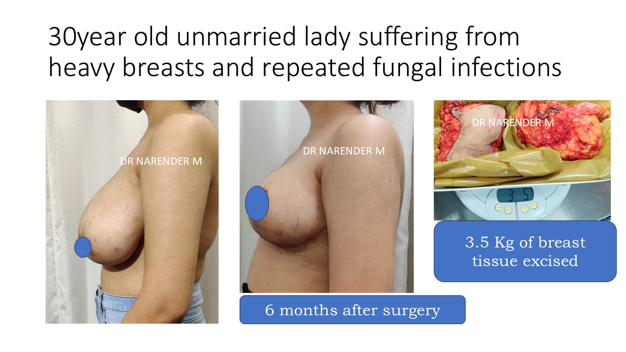 Breast Reduction Photo 12