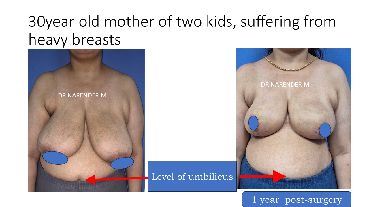 Breast Reduction Photo 13