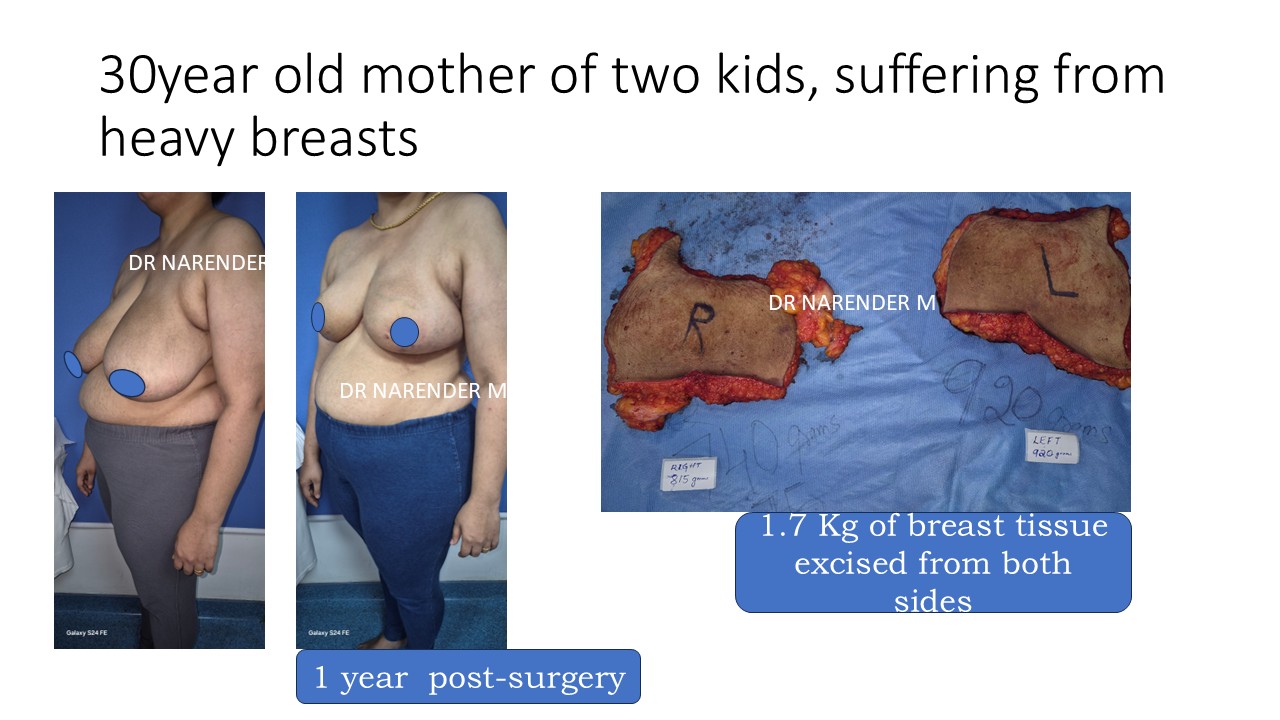 Breast Reduction Photo 14