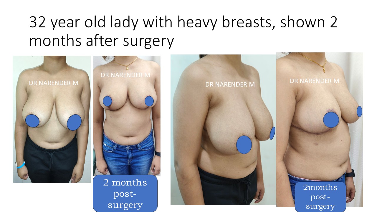 Breast Reduction Photo 15