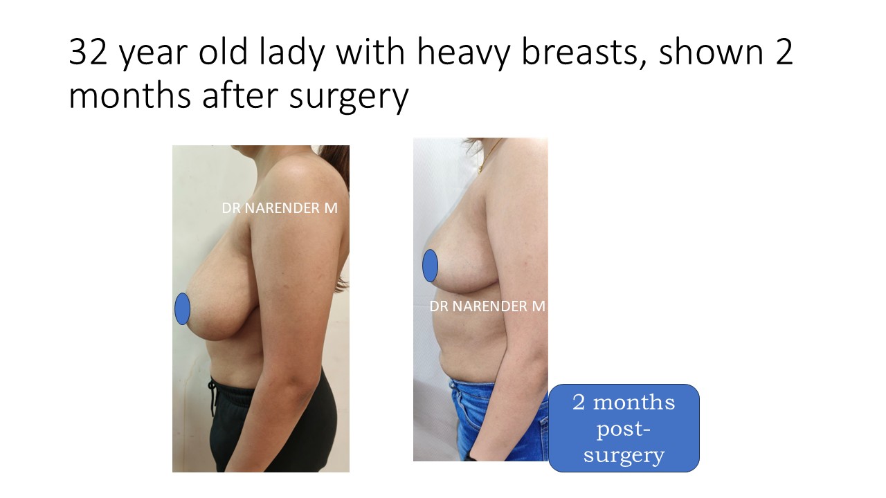 Breast Reduction Photo 16