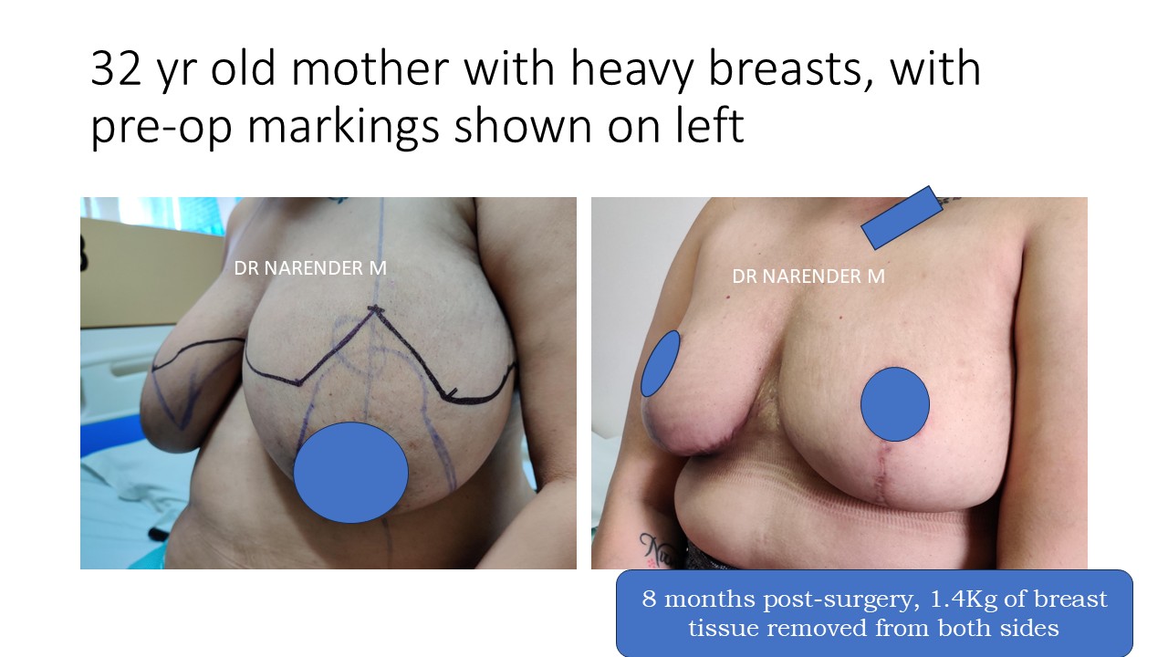 Breast Reduction Photo 2