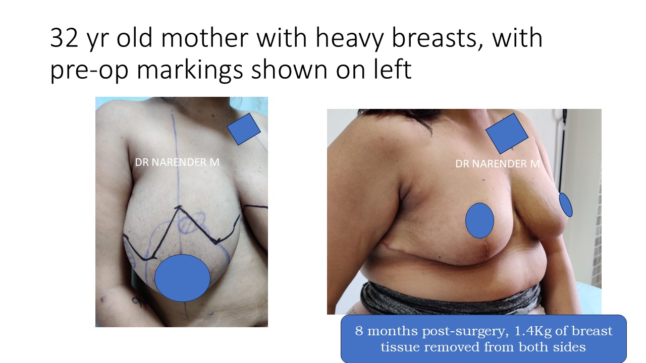 Breast Reduction Photo 3
