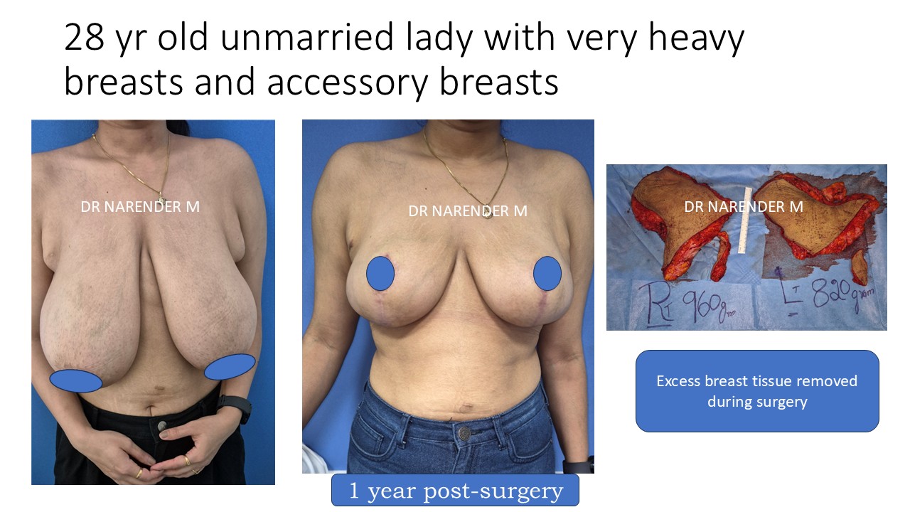 Breast Reduction Photo 4