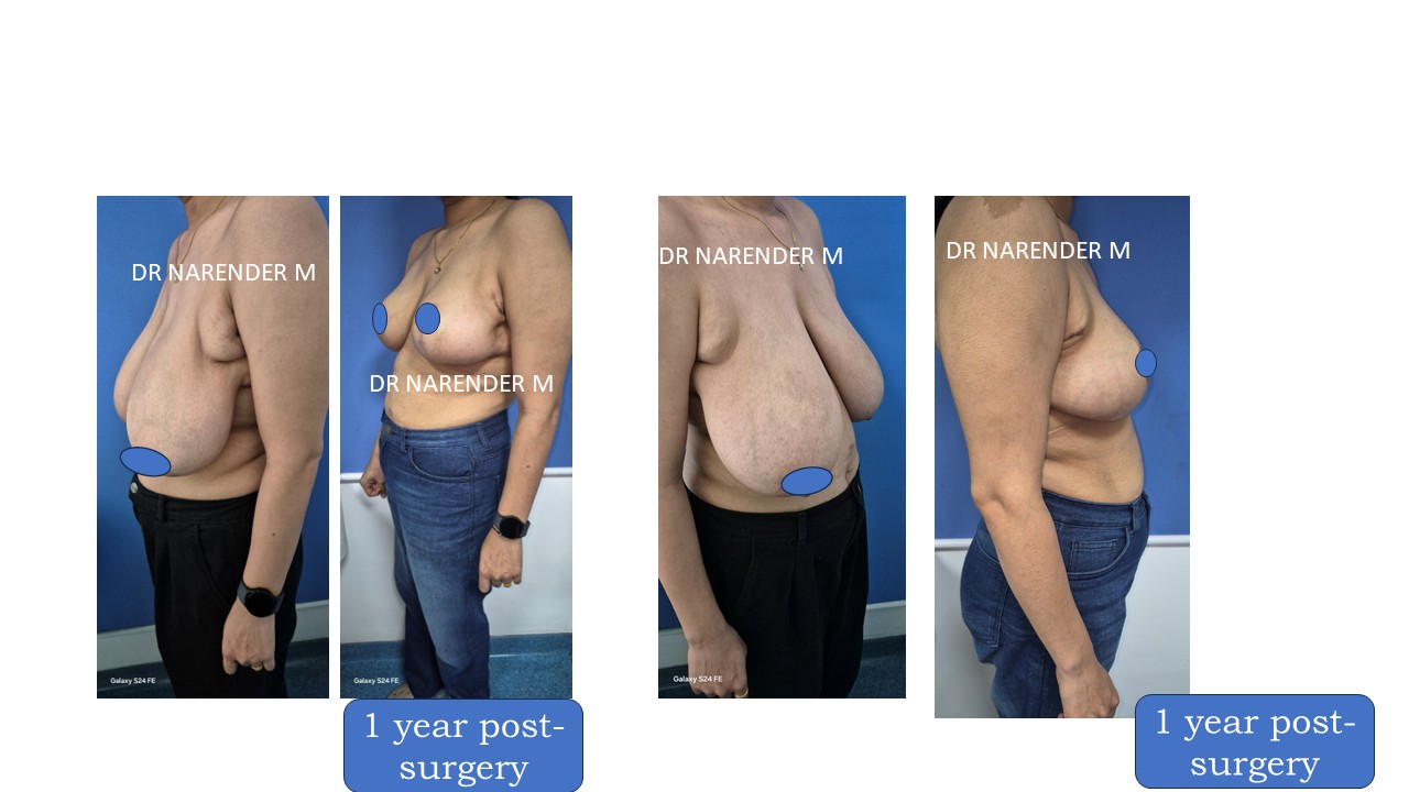 Breast Reduction Photo 5