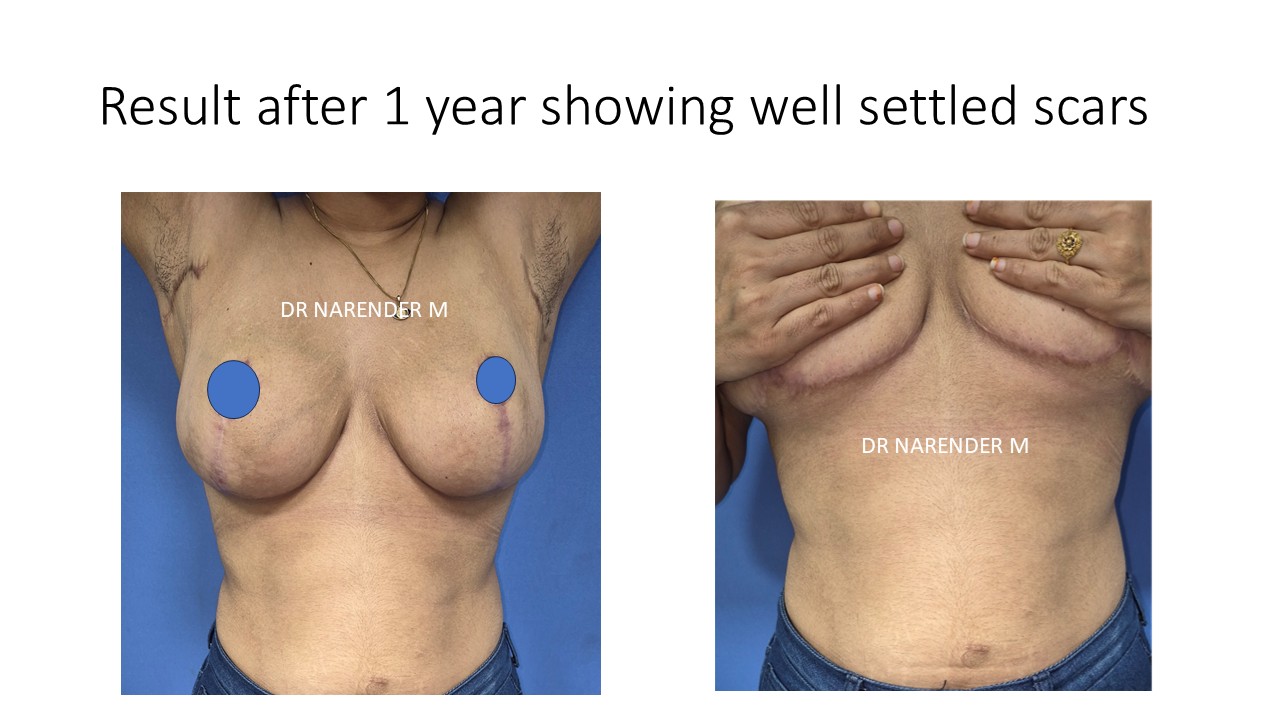 Breast Reduction Photo 6