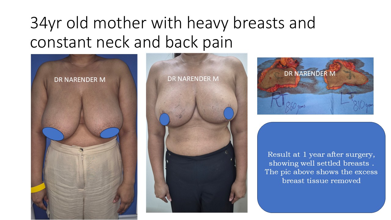 Breast Reduction Photo 7