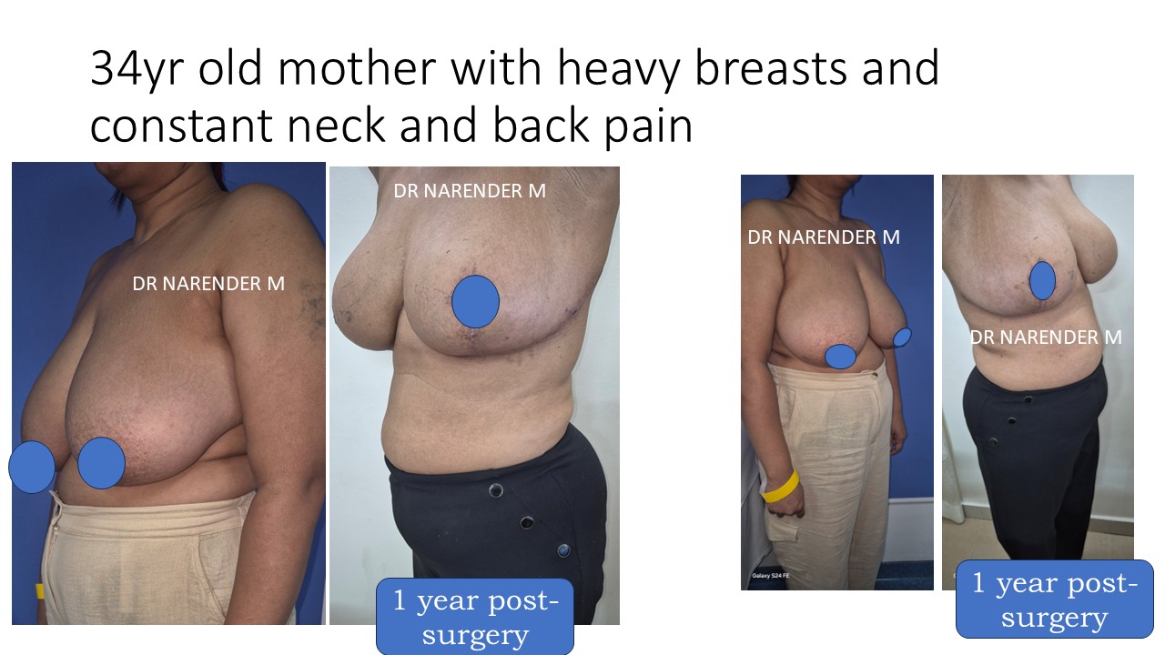 Breast Reduction Photo 8