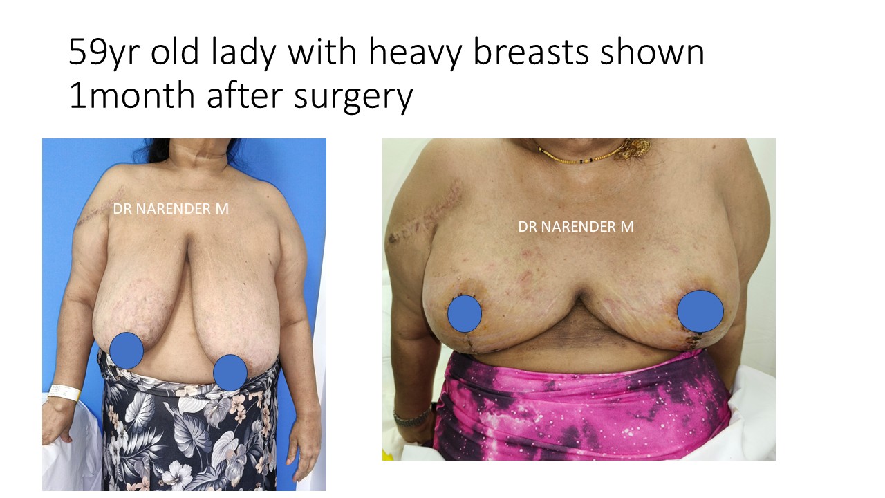 Breast Reduction Photo 9
