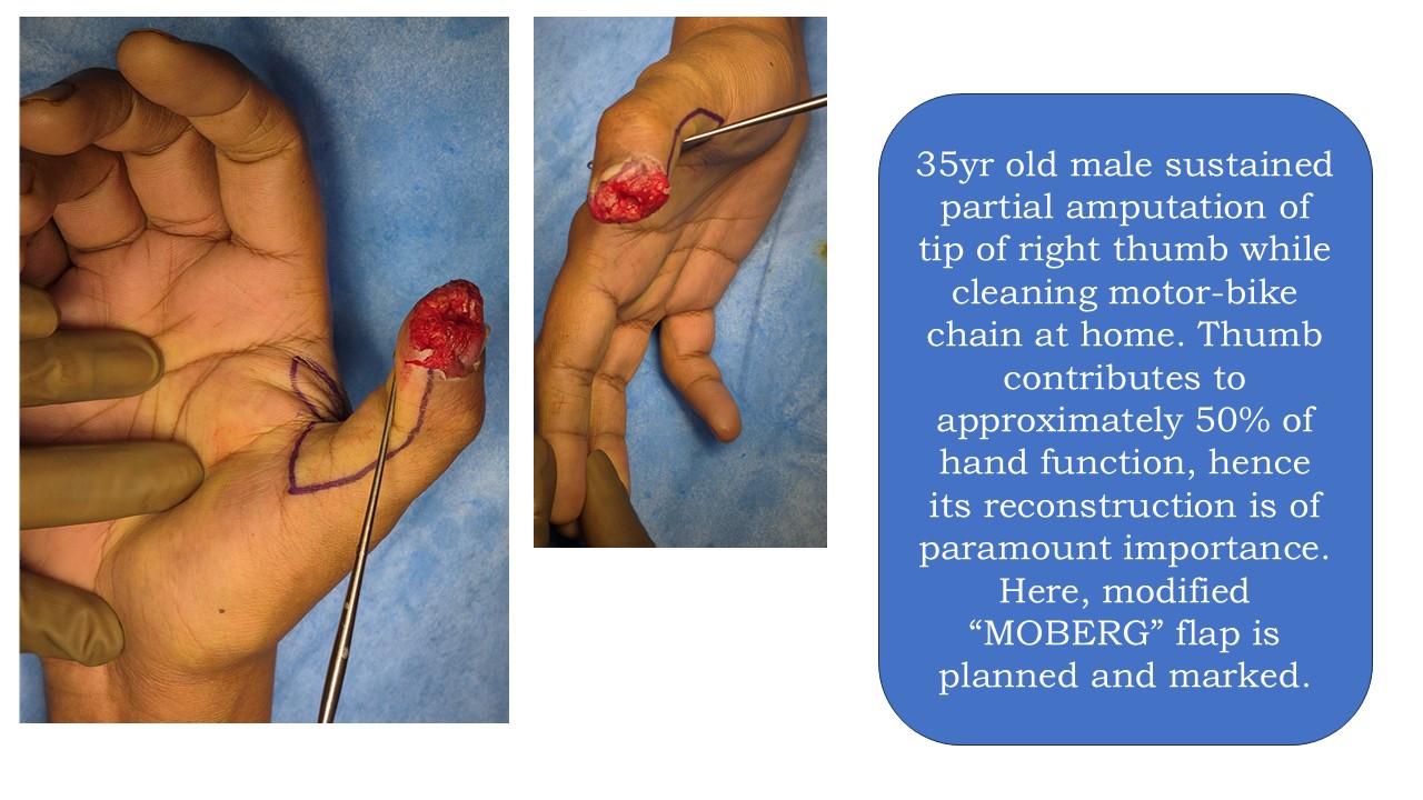 Hand Surgery Photo 1