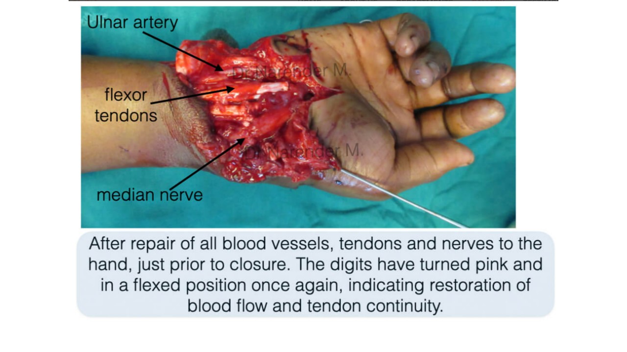 Hand Surgery Photo 10