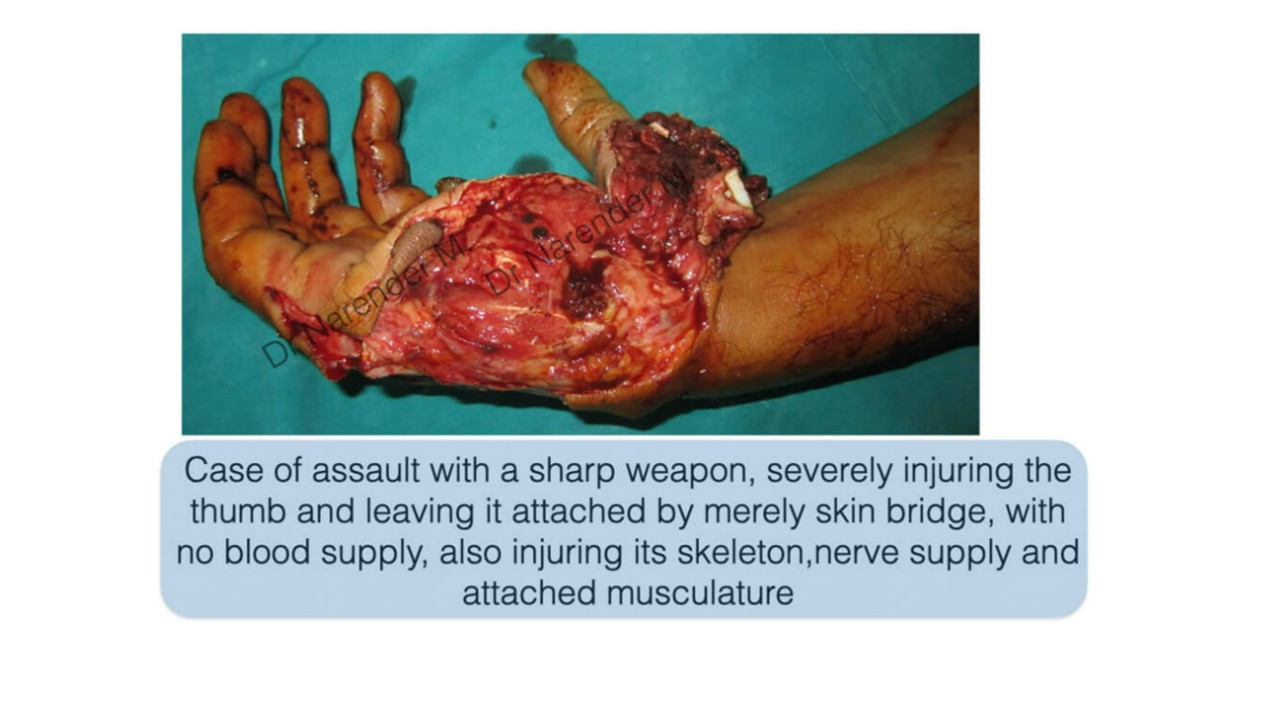 Hand Surgery Photo 11