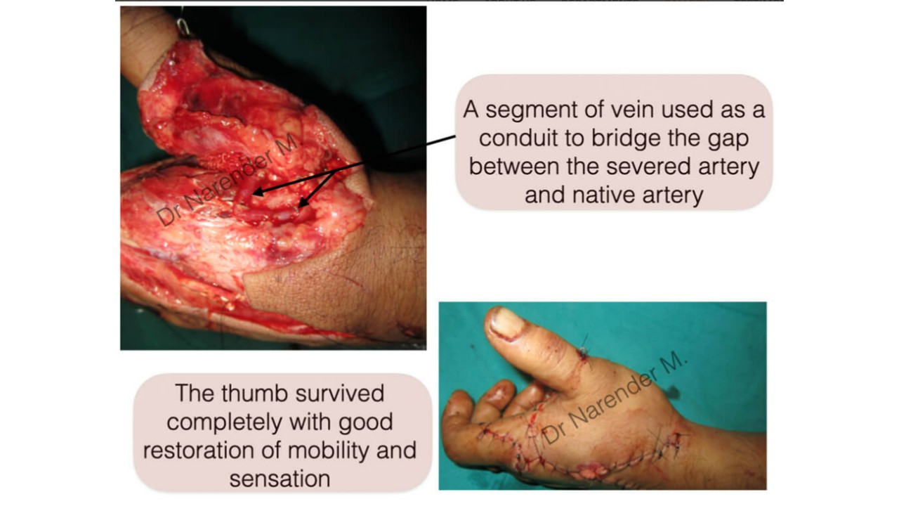 Hand Surgery Photo 12