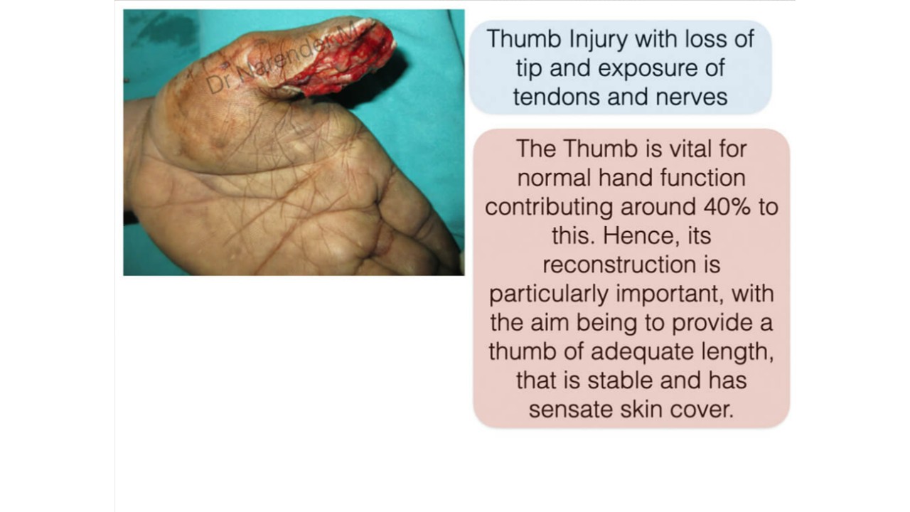 Hand Surgery Photo 13